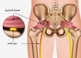 ما هي اسباب عرق النسا؟ 2 اسباب عرق النسا