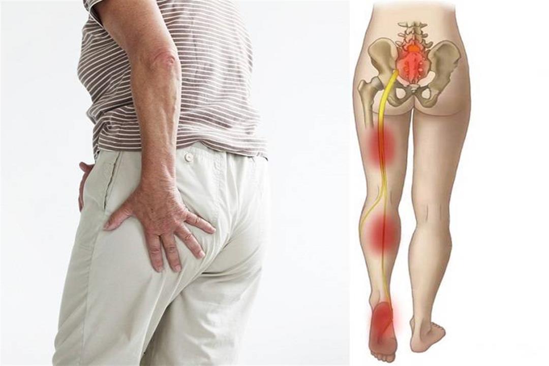 علاج عرق النسا في الرجل اليمنى بالتردد الحراري 1 علاج عرق النسا في الرجل اليمنى بالتردد الحراري