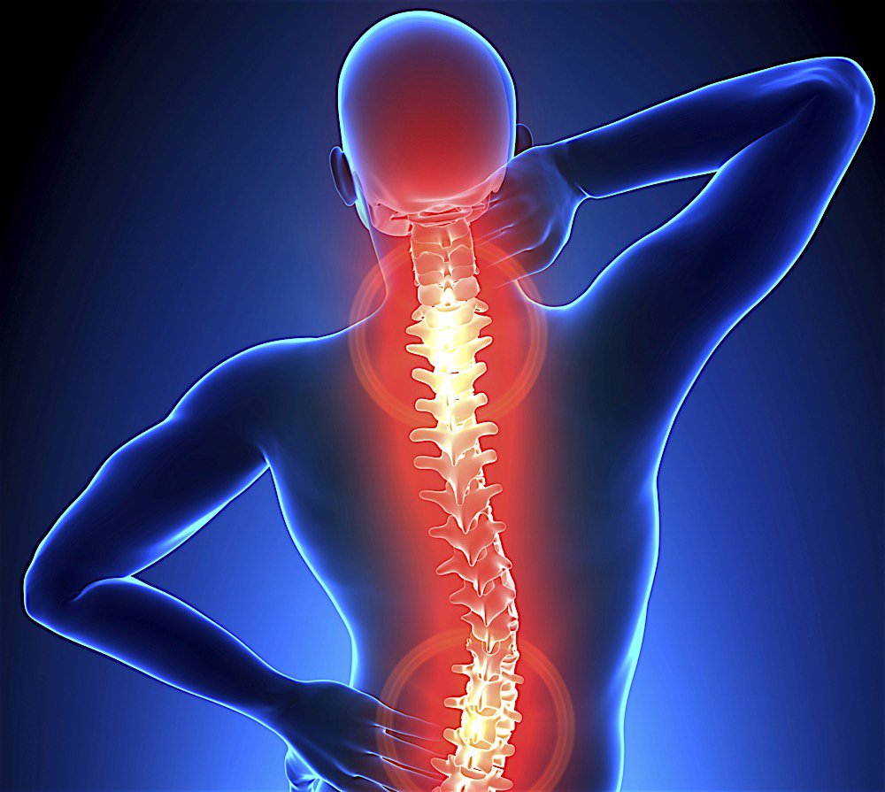 كيفية علاج الانزلاق الغضروفي العنقي