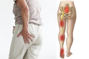 أحدث الأساليب في علاج عرق النسا