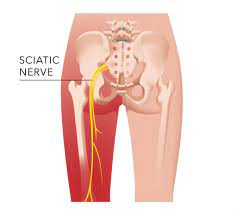 Foods to avoid for sciatica