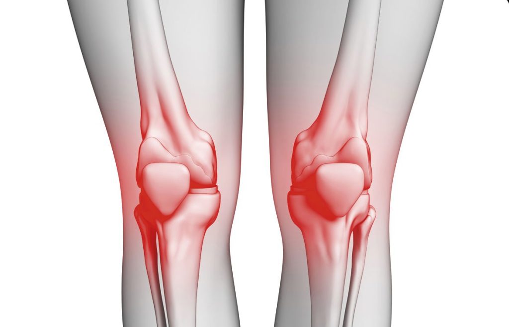 علاج آلام الركبة عند النساء