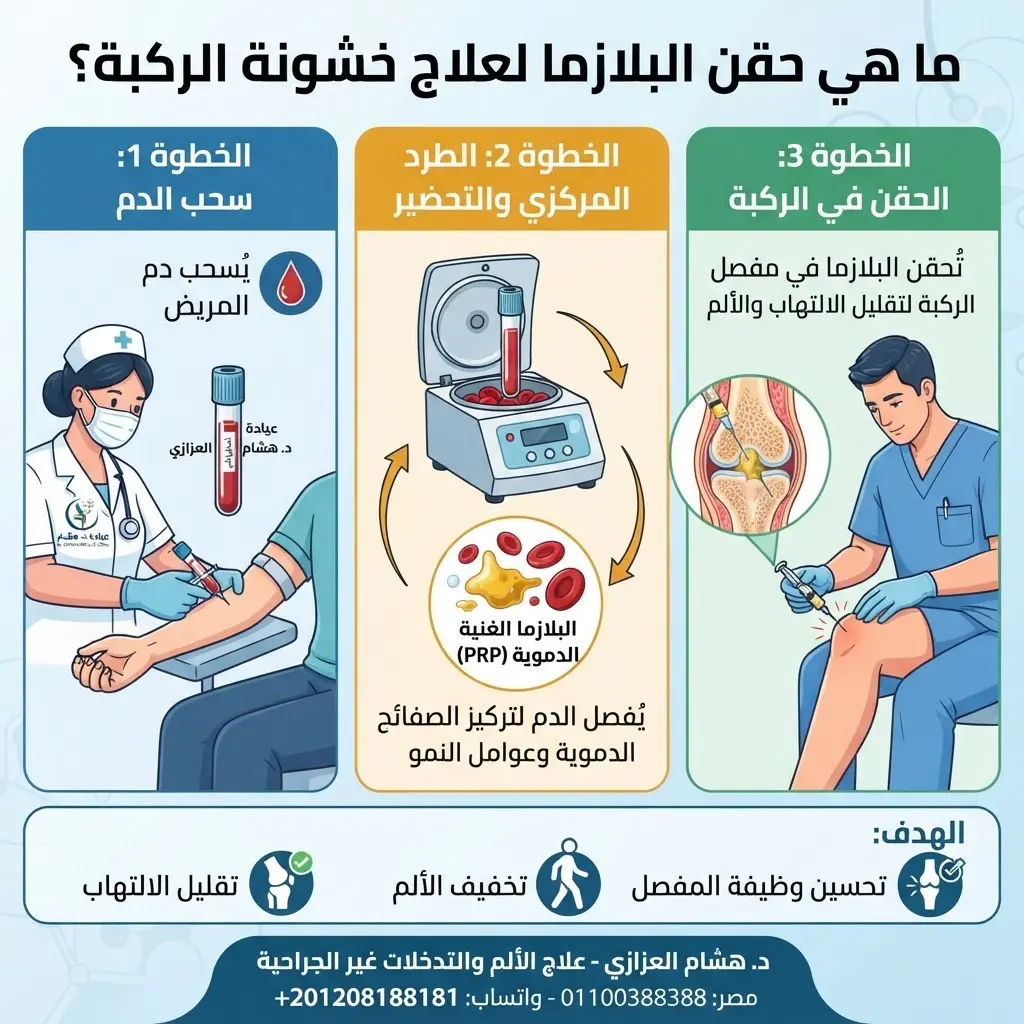 حقن البلازما لعلاج خشونة الركبة وتحسين الحركة